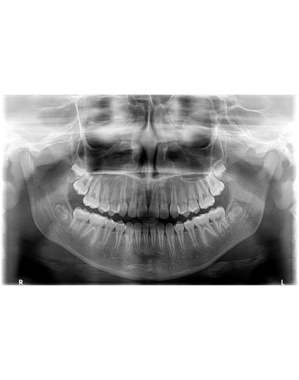 carestream kodak 9000c 3d cone beam cephalometric panoramic x ray sale